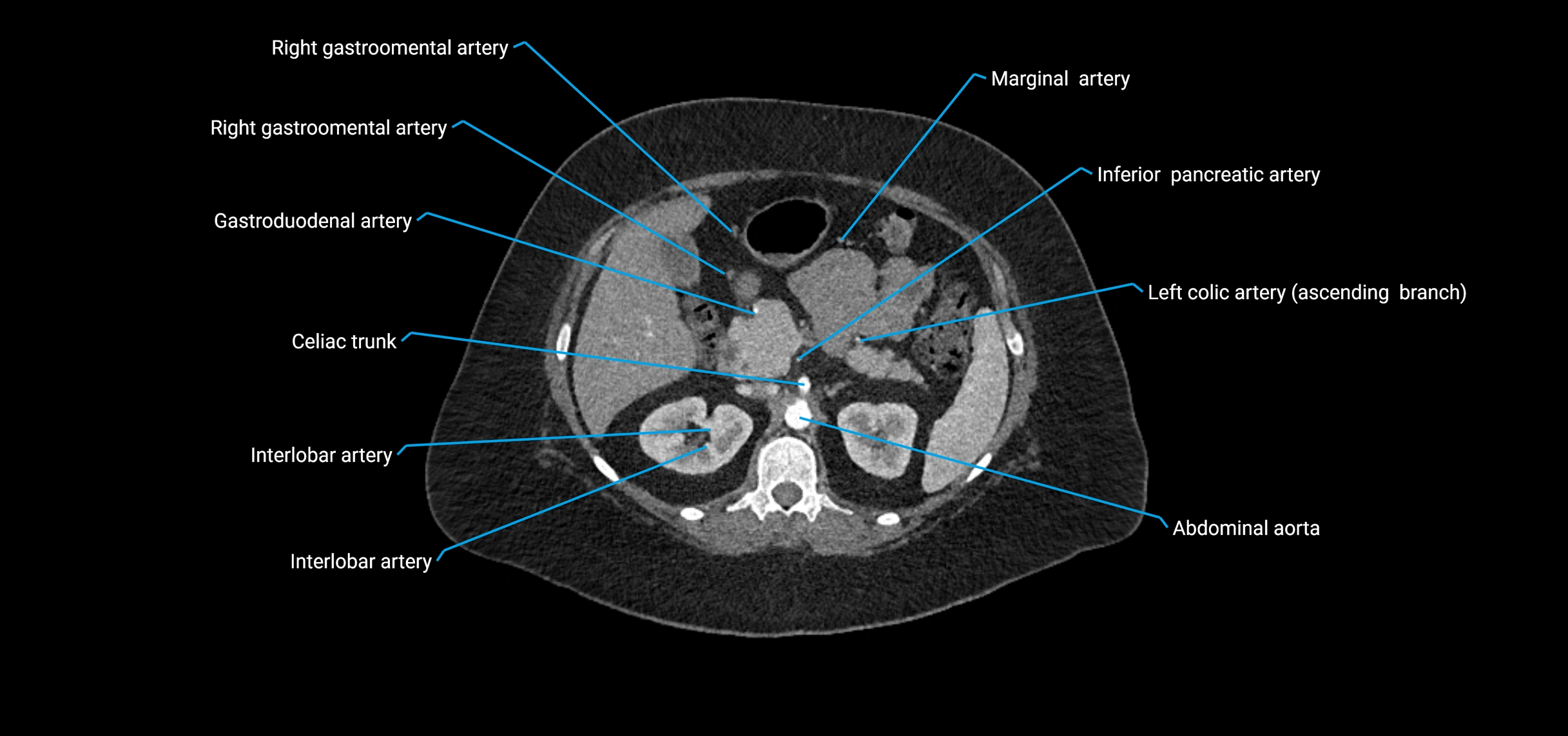 CTA abdomen axial cross sectional anatomy labelled image_61 (2).webp